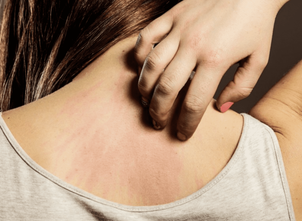 La dermatite atopique et démangeaisons quotidiennes 